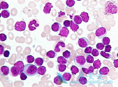 ³(IBRUTINIB)G-CSFRͻѪЧ