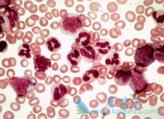ΪʲôӢNICE(nilotinib)ڶCML