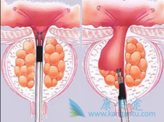 Ϊʲô(ABIRATERONE)ҩǰٰ