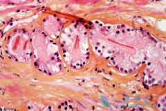 Ϊʲô߷ð(ABIRATERONE)ǰҪι