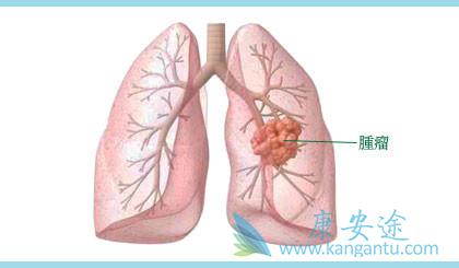 肺癌 肺癌