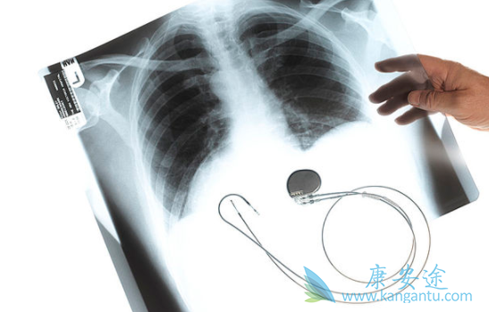 安罗替尼 安罗替尼