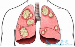��������(brigatinib)�Գ������ڷΰ����ߵ���Чզ����