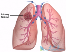 ���˿�������ALK���Էΰ����ߵ�һ����ҩ������Щ��