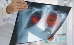 ��������(crizotinib)�����ڼ仼��Ҫ������ת��