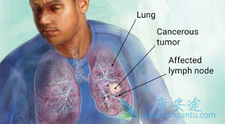 NSCLC����