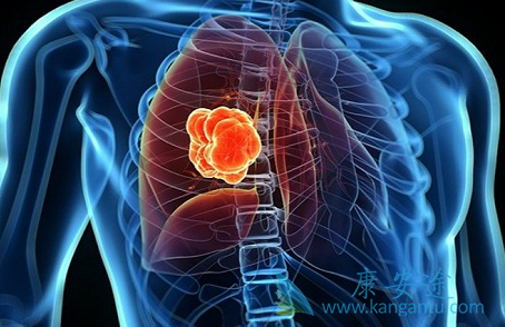 伽马刀治疗肺癌 伽马刀治疗肺癌