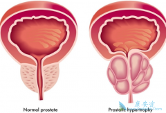 ǰ���ٰ��ܻ��ã�����ǰ���ٰ�֢״����Щ��