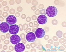 ��Щ����ҩ��������������(rituximab)��������CLL��