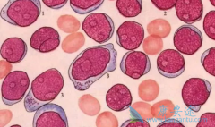 ���������쳣�ۺ�֢��ƶѪΪ��Ҫ�ٴ�����