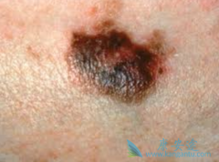 ���������Щ֢״˵����ɫ�����Ѿ���չ�������ˣ�