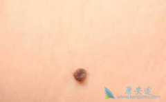 �˽�Ƥ����֢������֢״�����ڻ������տ�ʼ����