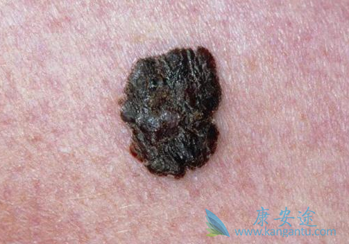 ʲô�Ǻ�ɫ����