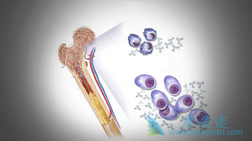 多发性骨髓瘤 多发性骨髓瘤