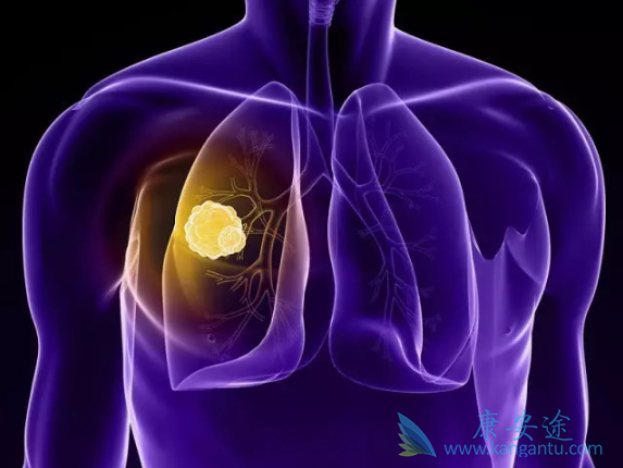 非小细胞肺癌 非小细胞肺癌