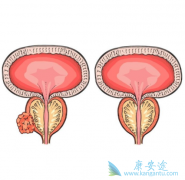 ʲô��ǰ���ٰ���ת�ƣ�ǰ���ٰ�֢��ת�ƺ�������