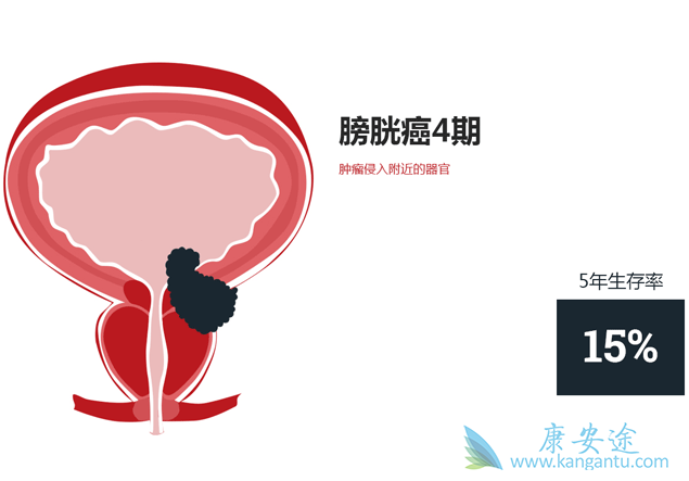 膀胱癌晚期症状 膀胱癌晚期症状