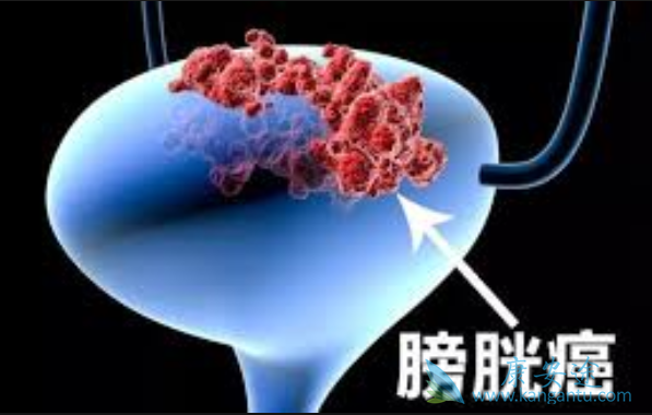 膀胱癌晚期 膀胱癌晚期
