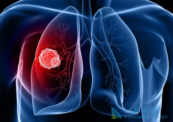 肺癌化疗 肺癌化疗