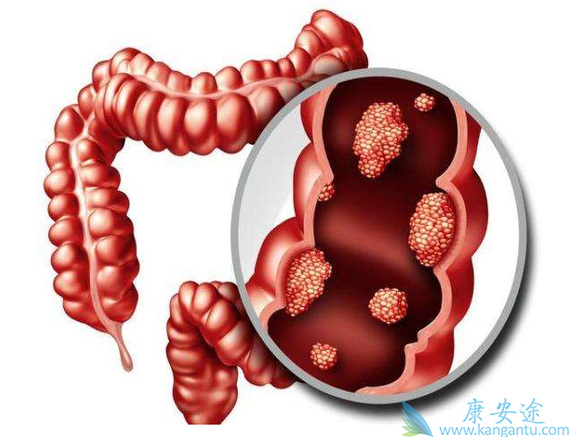 消化道肿瘤 消化道肿瘤