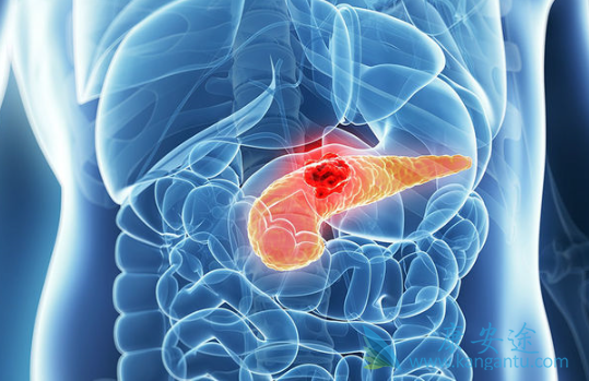 胰腺癌 胰腺癌