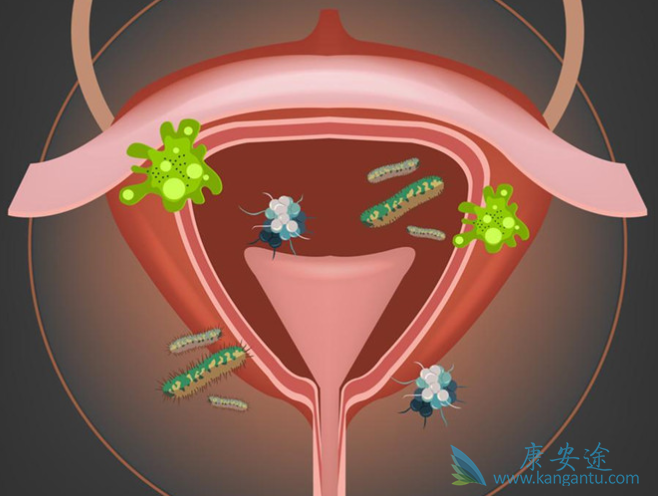 膀胱癌晚期症状 膀胱癌晚期症状
