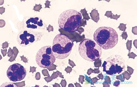 ���������쳣�ۺ�֢