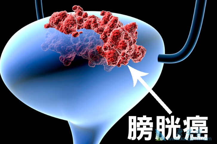膀胱癌的早期症状 膀胱癌的早期症状