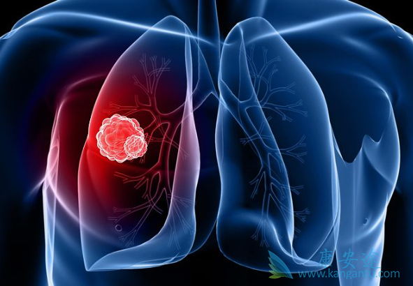 肺癌化疗 肺癌化疗