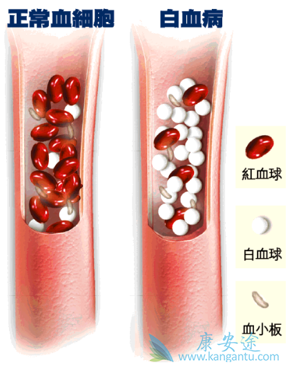 白血病治疗 白血病治疗