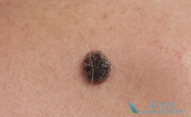 黑色素瘤 黑色素瘤