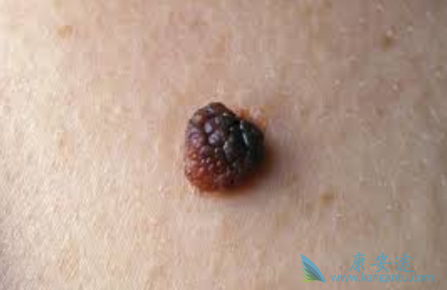 黑色素瘤 黑色素瘤