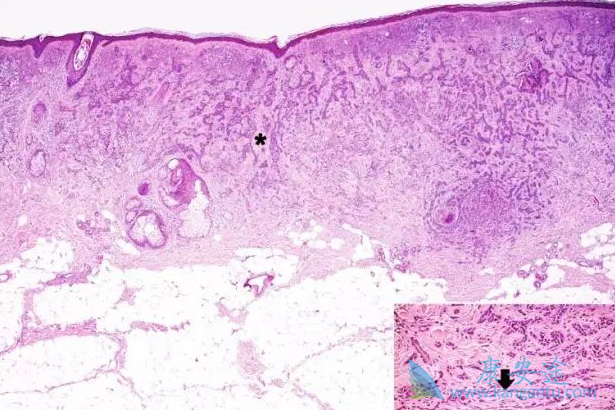 基底细胞癌 基底细胞癌