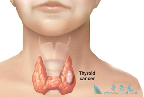 甲状腺癌症 甲状腺癌症