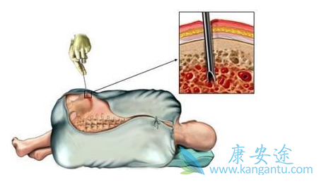 骨髓移植 骨髓移植