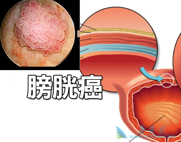 膀胱癌 膀胱癌