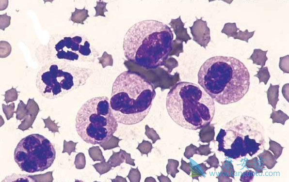 ���������쳣�ۺ�֢