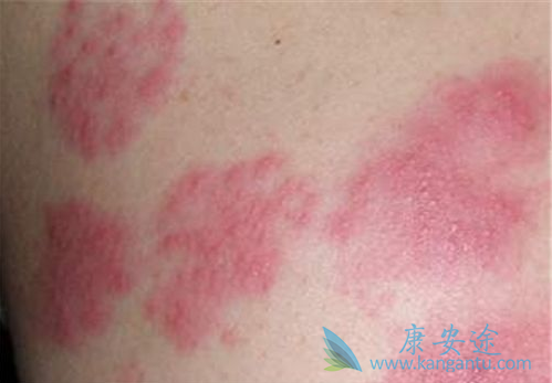 皮疹怎么治疗 皮疹怎么治疗
