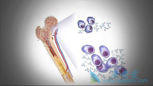 多发性骨髓瘤症状 多发性骨髓瘤症状