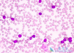 �ܰͰ�֢״����Щ���ܰͰ�������ʲô��