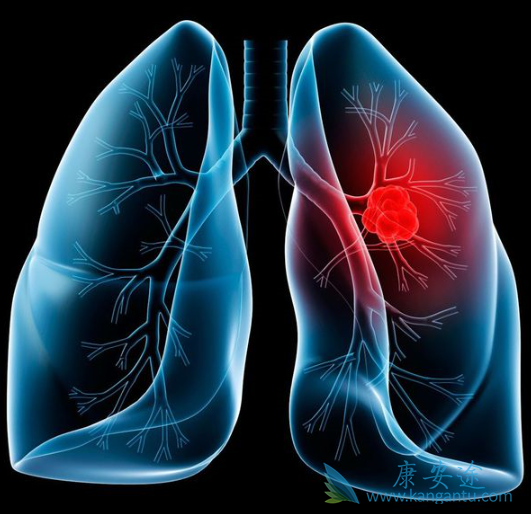 肺癌晚期症状 肺癌晚期症状