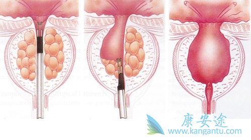 膀胱癌晚期 膀胱癌晚期