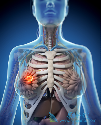 乳腺癌分期 乳腺癌分期