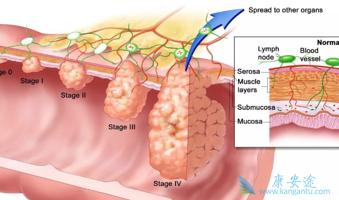 直肠癌患者 直肠癌患者