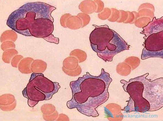 多发性骨髓瘤症状 多发性骨髓瘤症状