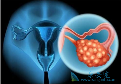 卵巢癌晚期 卵巢癌晚期