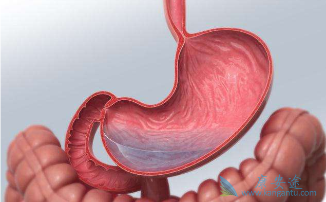 胃癌晚期 胃癌晚期