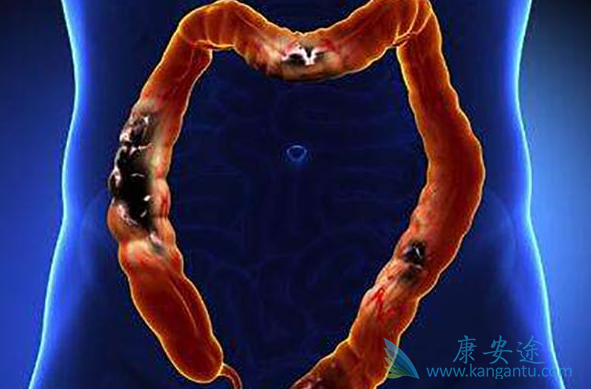 结直肠癌 结直肠癌